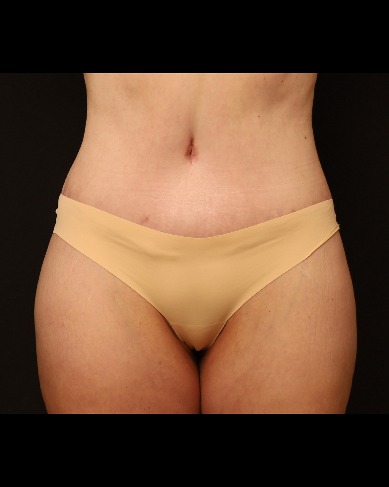 Tummy Tuck Before and After 07