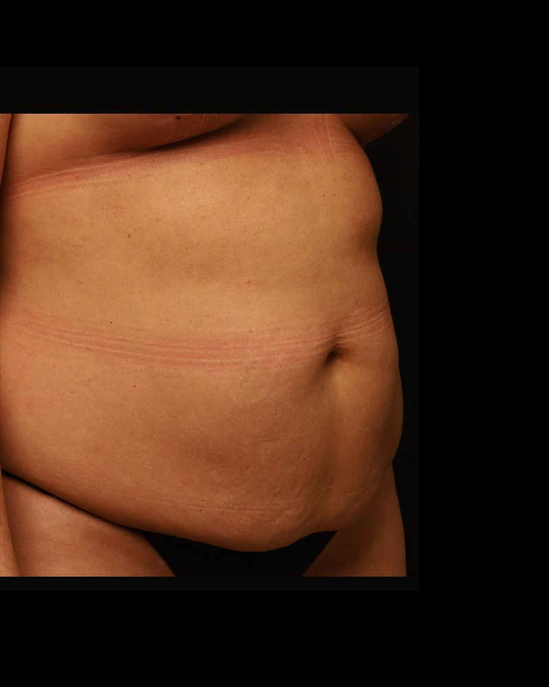 Tummy Tuck Before and After 26
