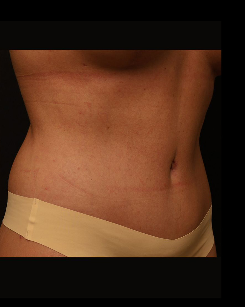 Tummy Tuck Before and After 26