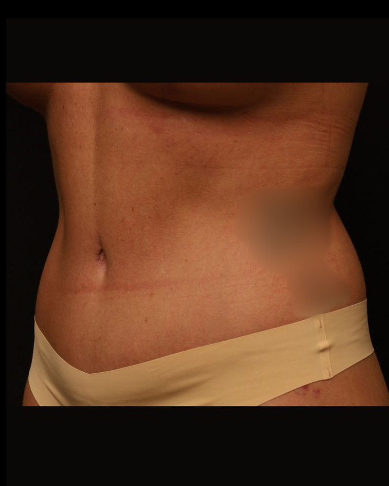 Tummy Tuck Before and After 26