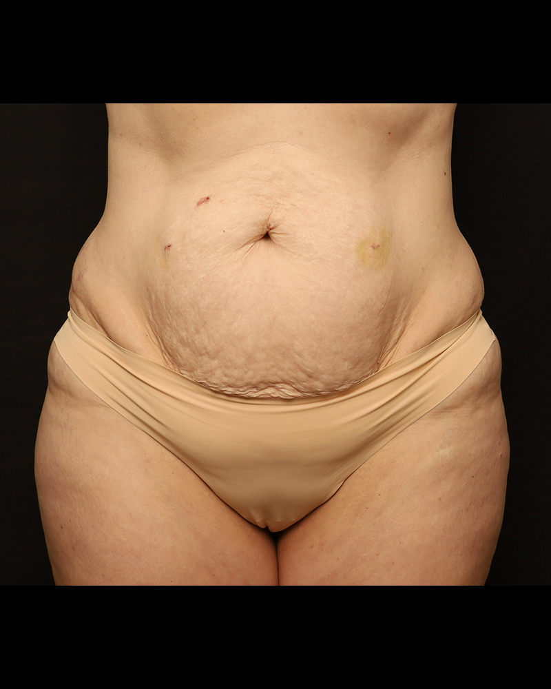 Tummy Tuck Before and After 27