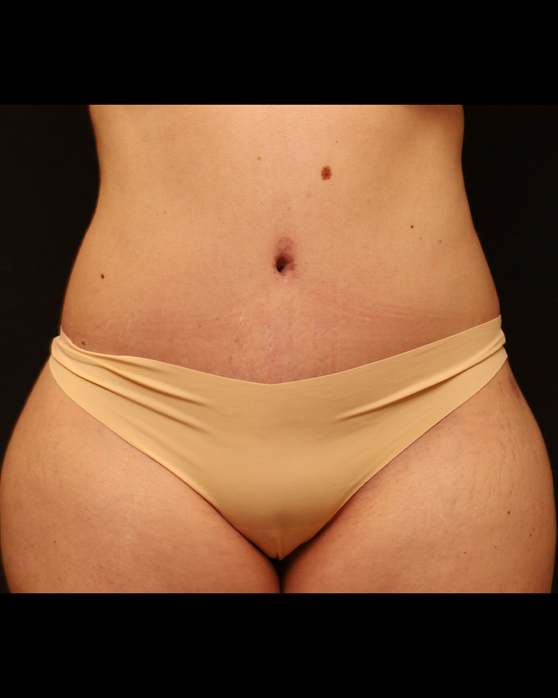 Tummy Tuck Before and After 07