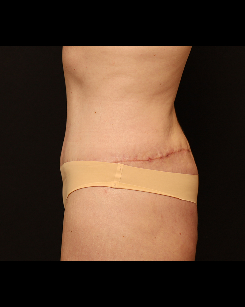 Tummy Tuck Before and After 27