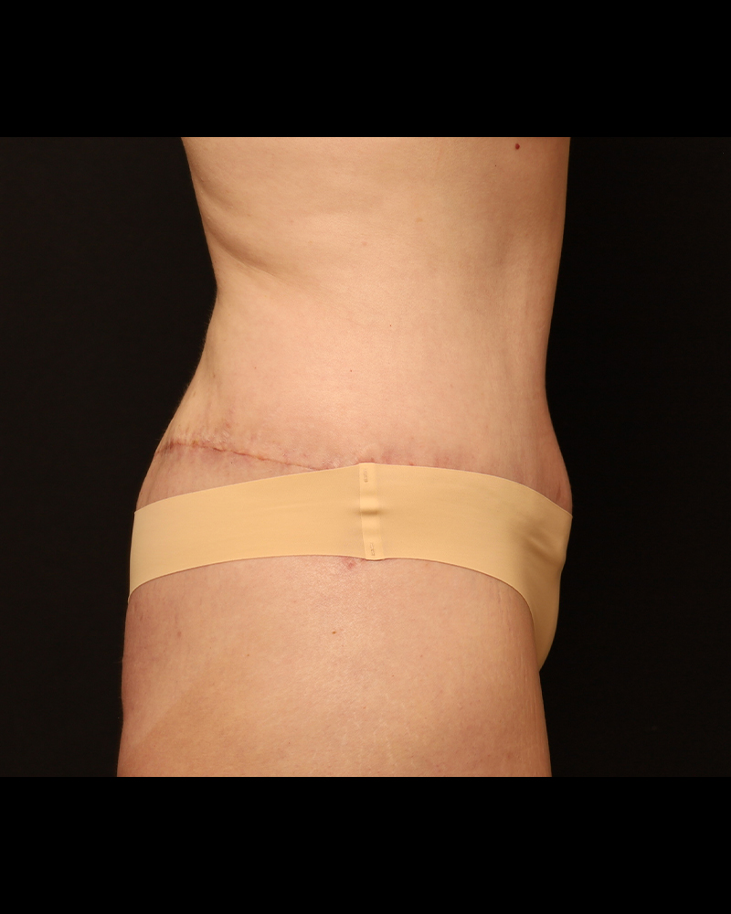 Tummy Tuck Before and After 27