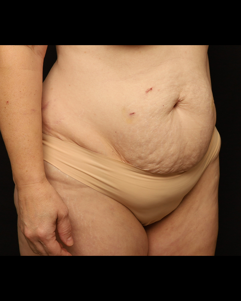 Tummy Tuck Before and After 27