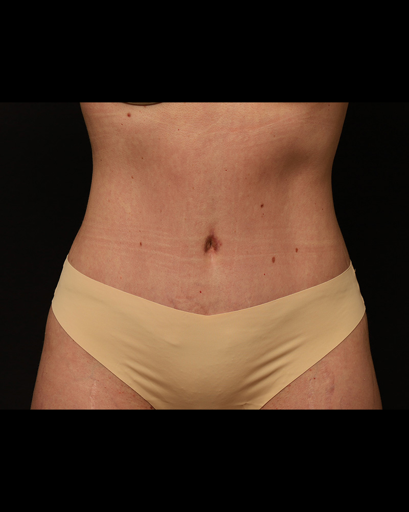 Tummy Tuck Before and After 07