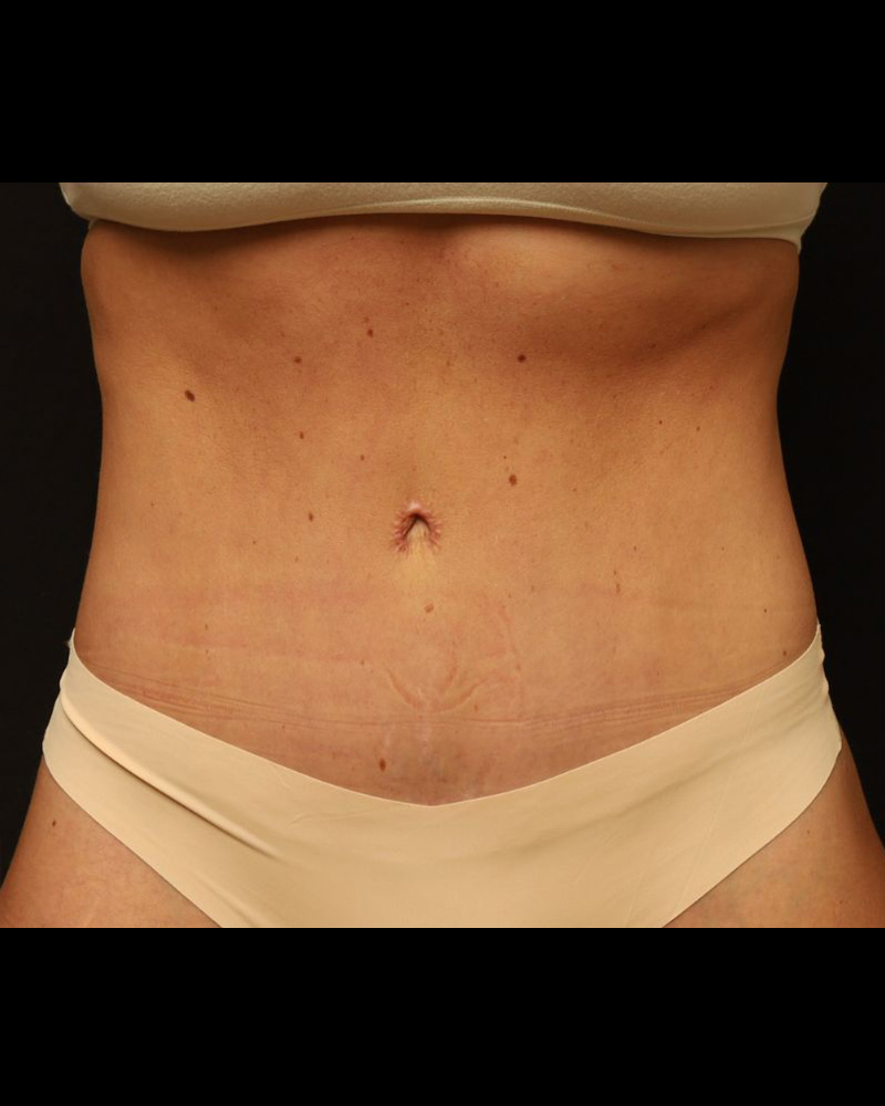 Tummy Tuck Before and After 07