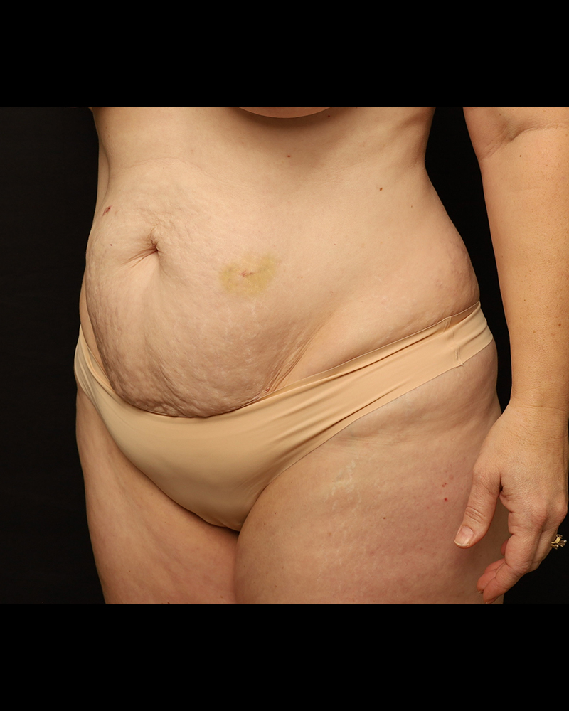 Tummy Tuck Before and After 29
