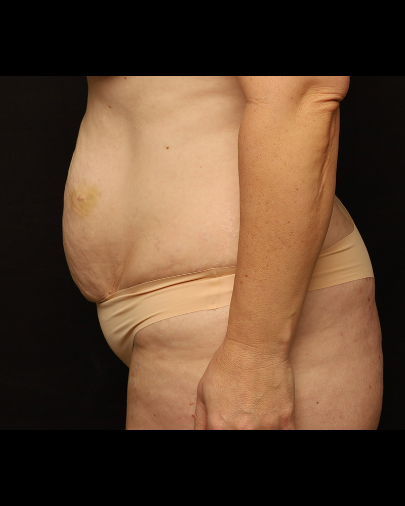 Tummy Tuck Before and After 29