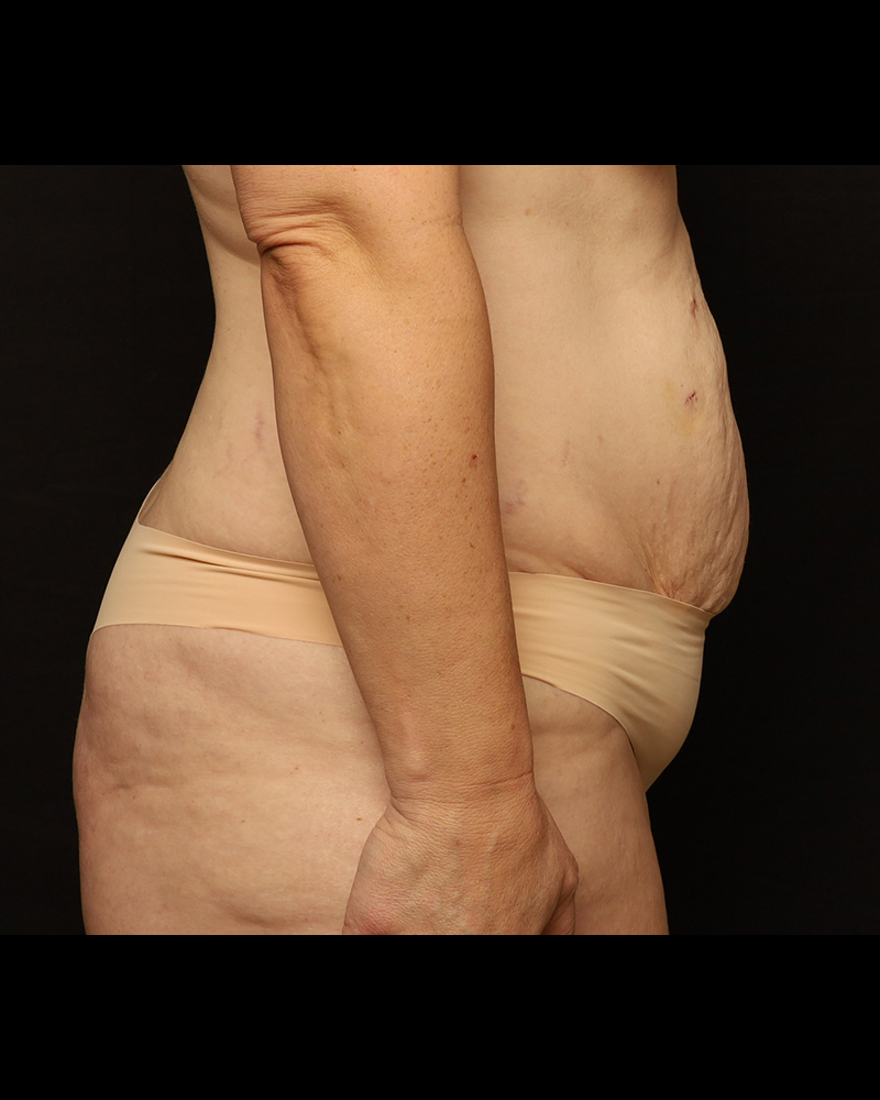 Tummy Tuck Before and After 29