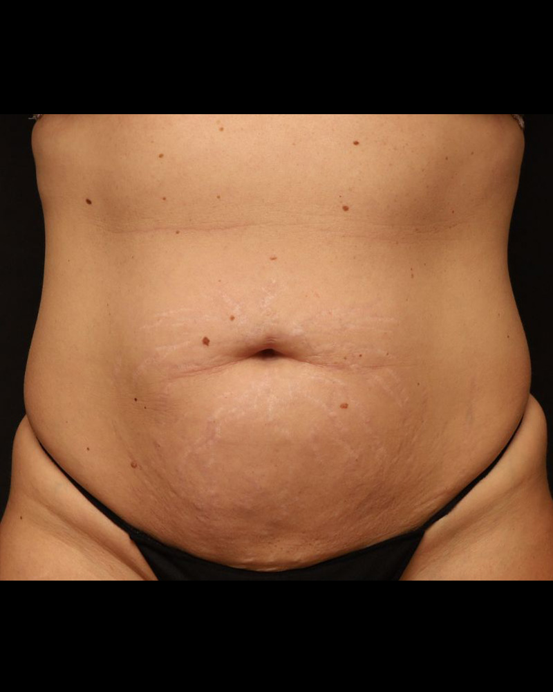 Tummy Tuck Before and After 30