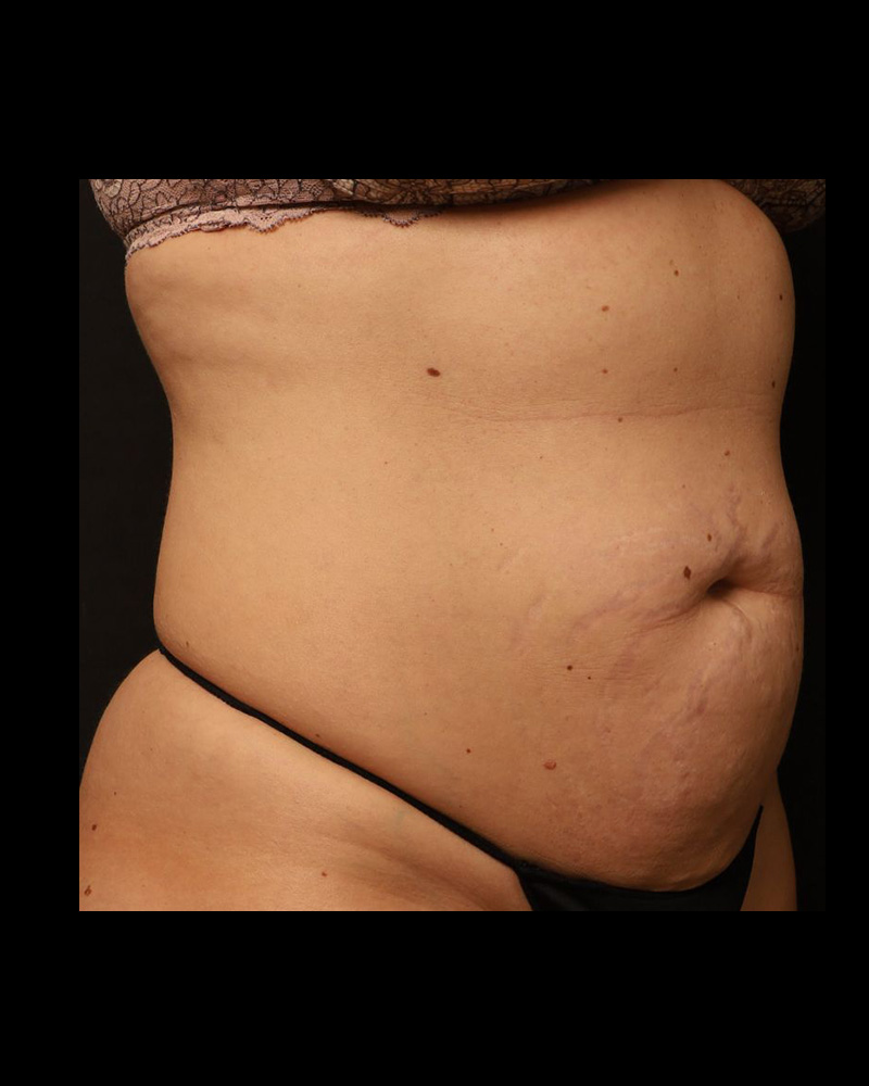 Tummy Tuck Before and After 30