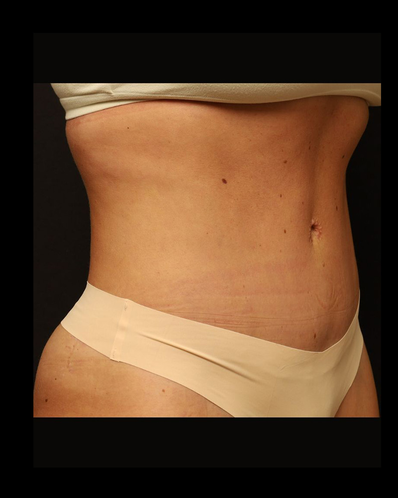 Tummy Tuck Before and After 30