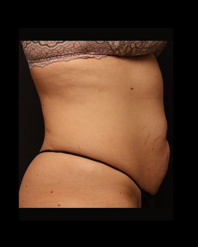 Tummy Tuck Before and After 30