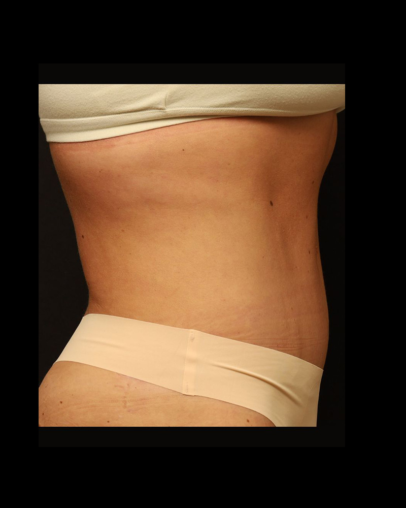 Tummy Tuck Before and After 30