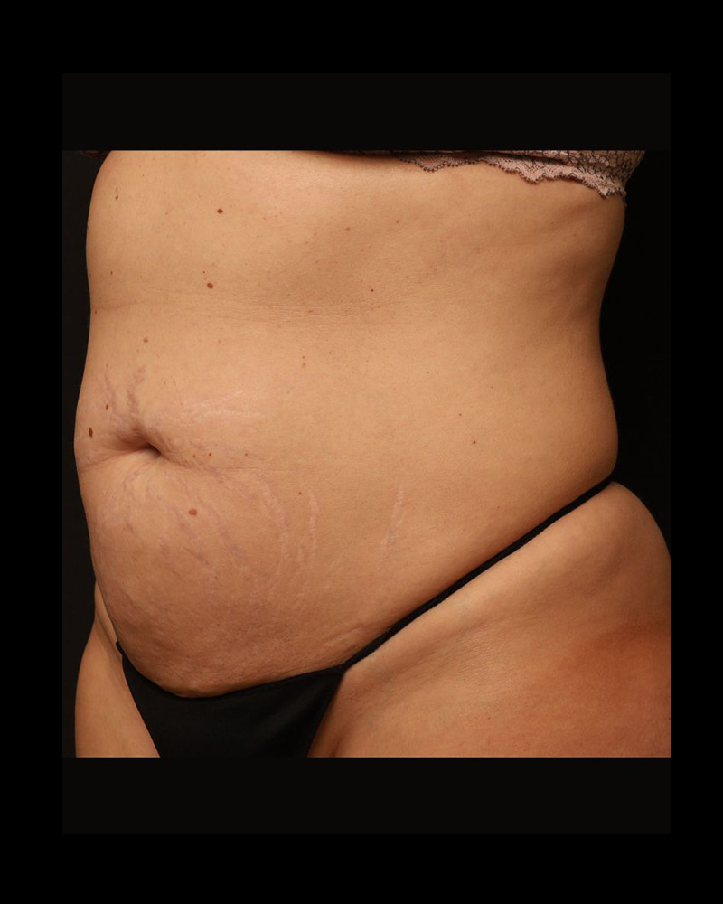 Tummy Tuck Before and After 30