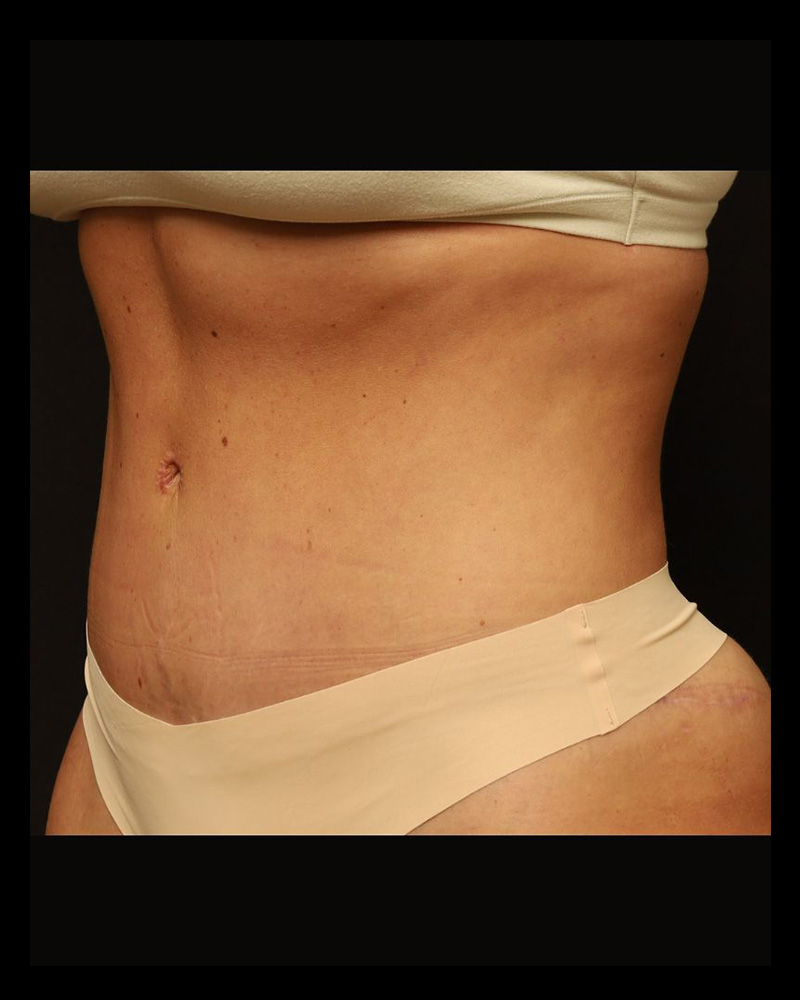Tummy Tuck Before and After 30