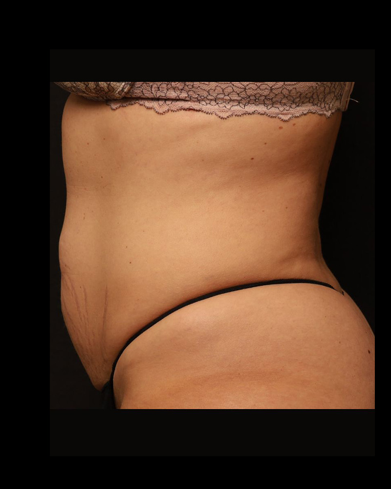 Tummy Tuck Before and After 30