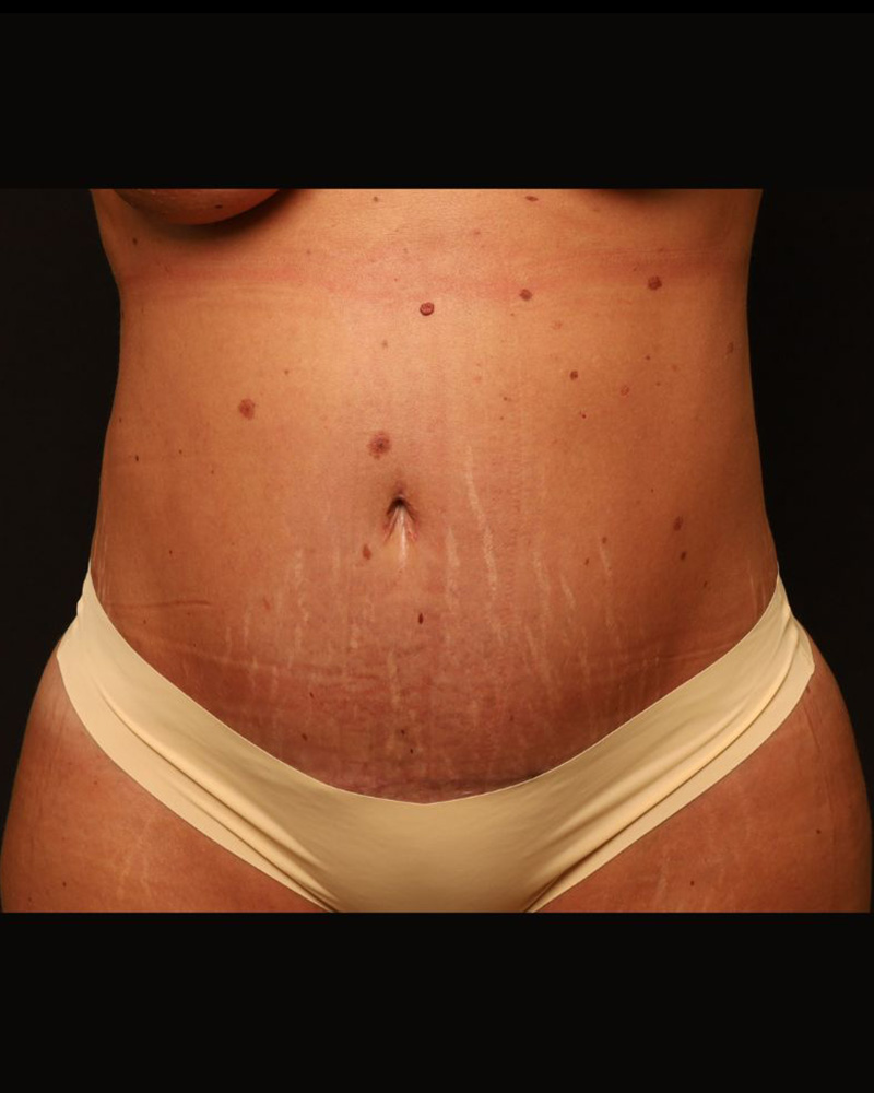 Tummy Tuck Before and After 07