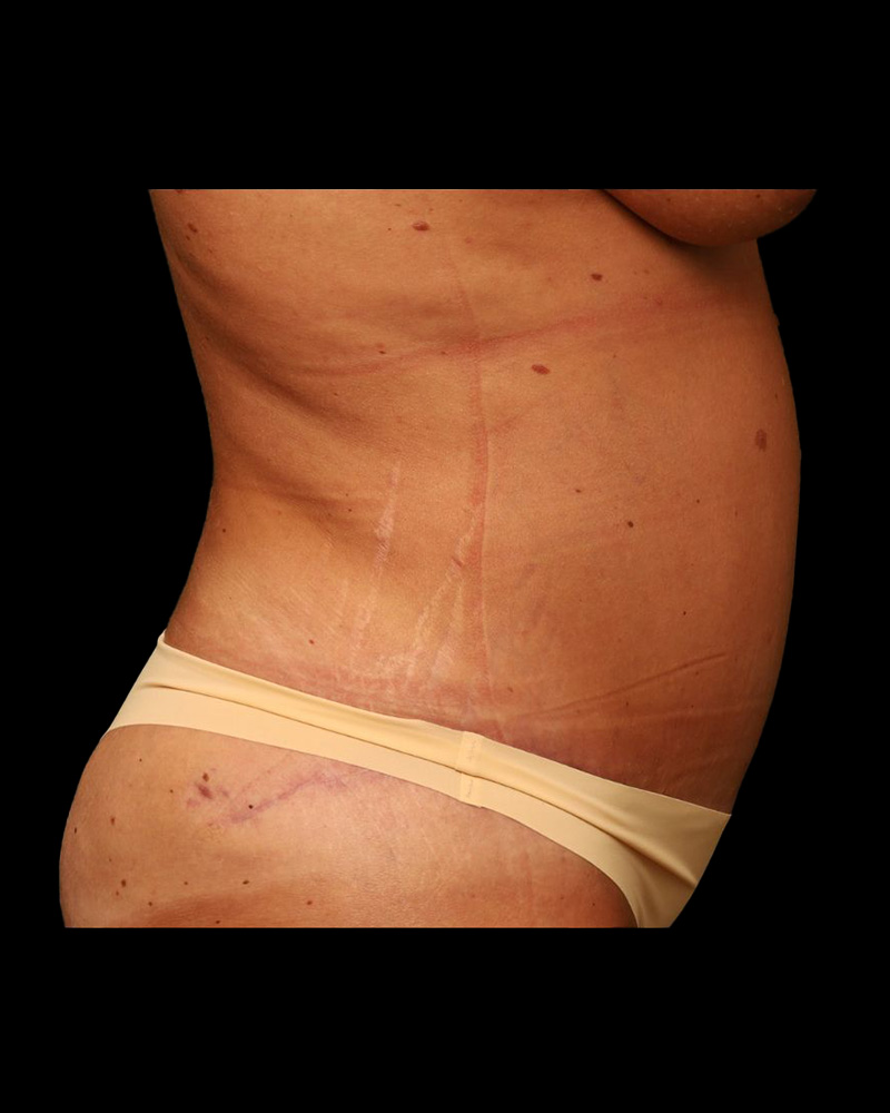 Tummy Tuck Before and After 31