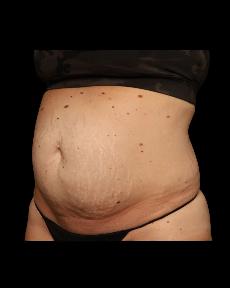 Tummy Tuck Before and After 31