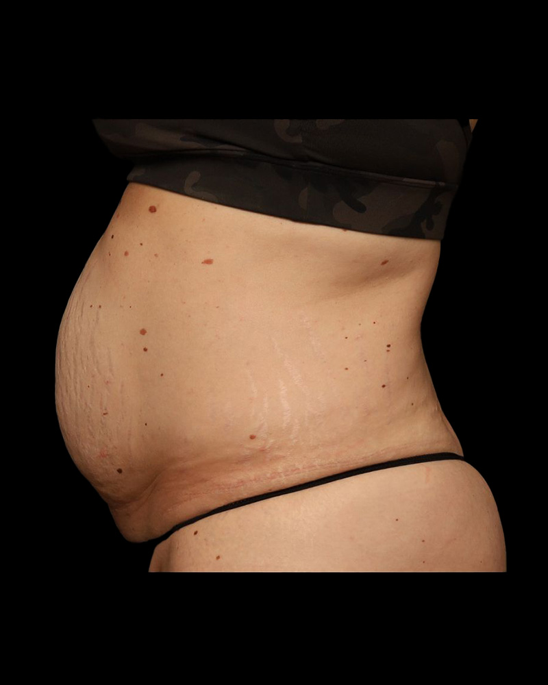 Tummy Tuck Before and After 31