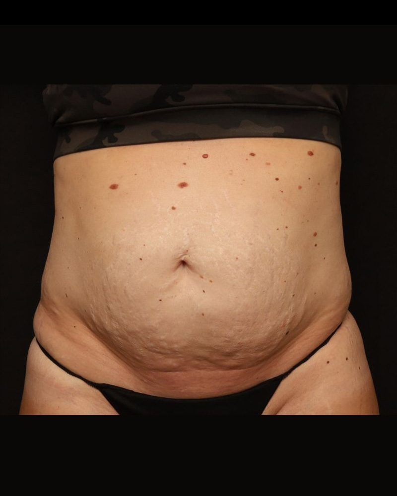 Tummy Tuck Before and After 32