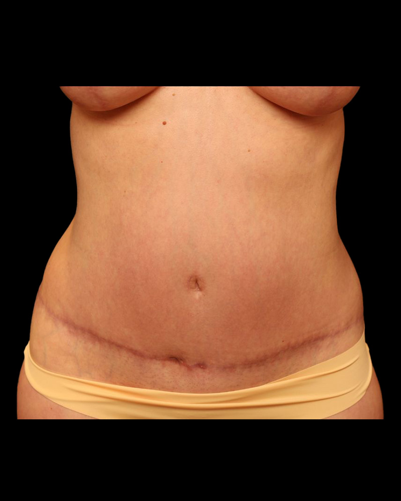 Tummy Tuck Before and After 07