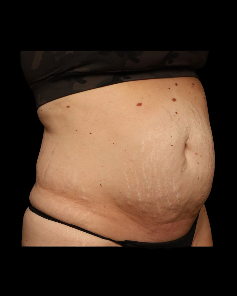 Tummy Tuck Before and After 32