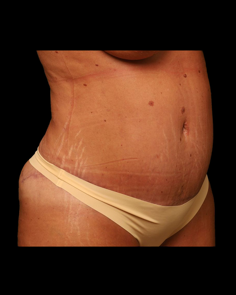 Tummy Tuck Before and After 32