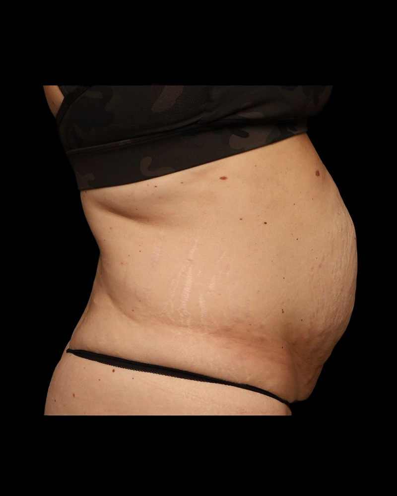 Tummy Tuck Before and After 32