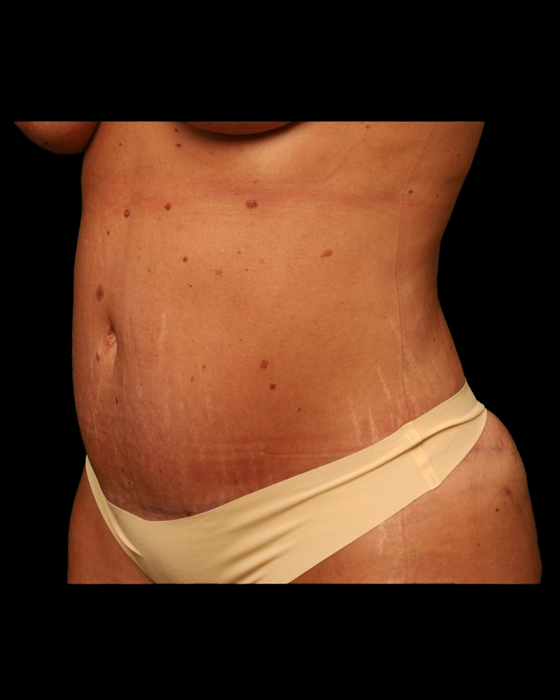 Tummy Tuck Before and After 32