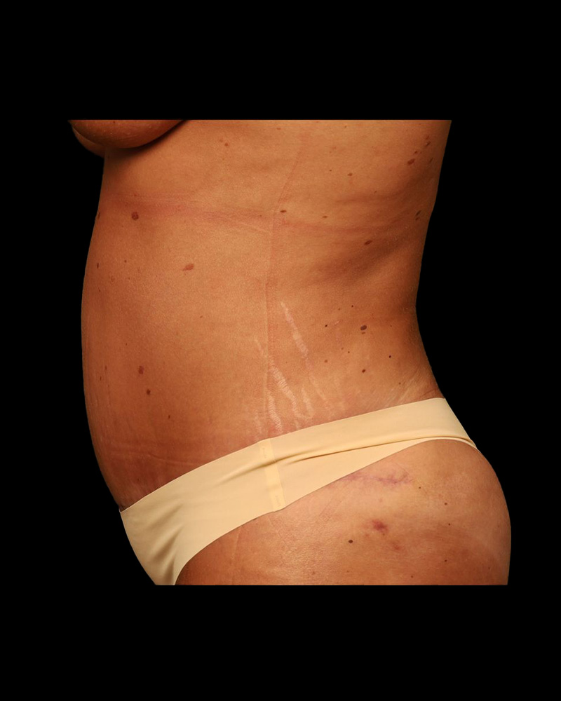 Tummy Tuck Before and After 32