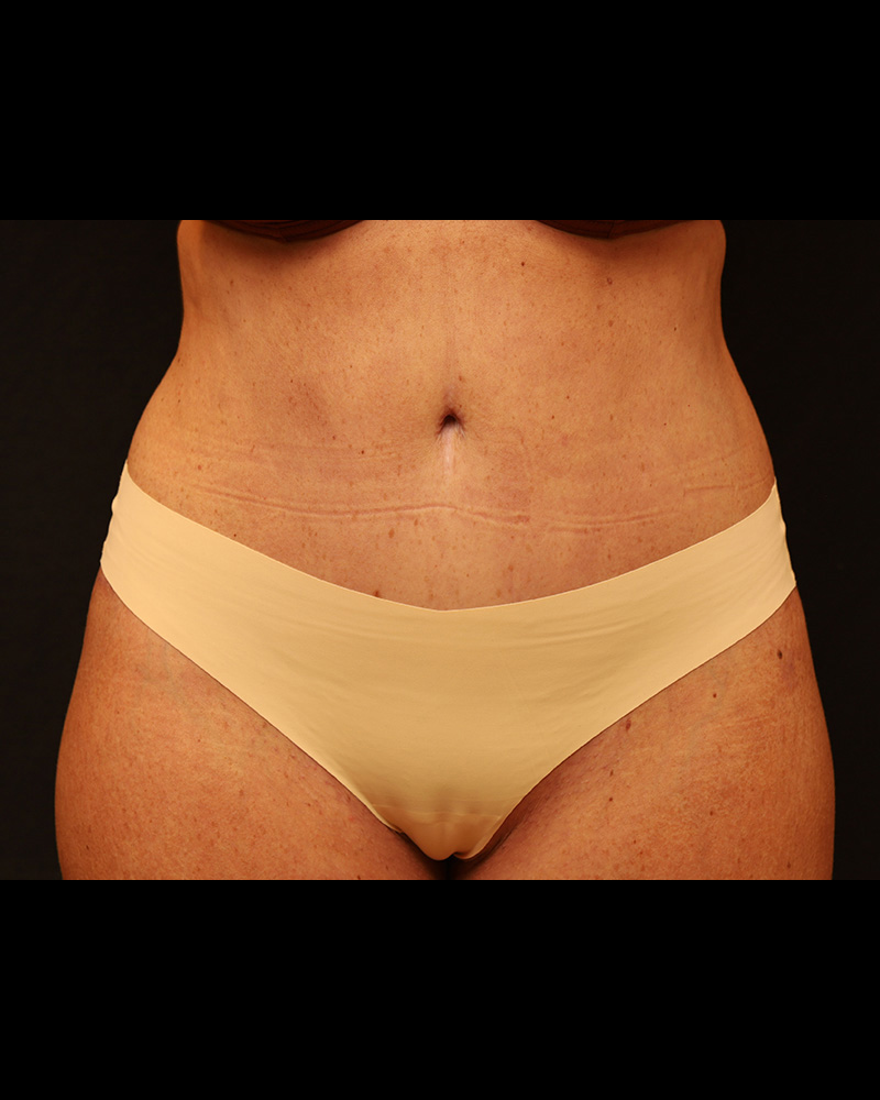 Tummy Tuck Before and After 07