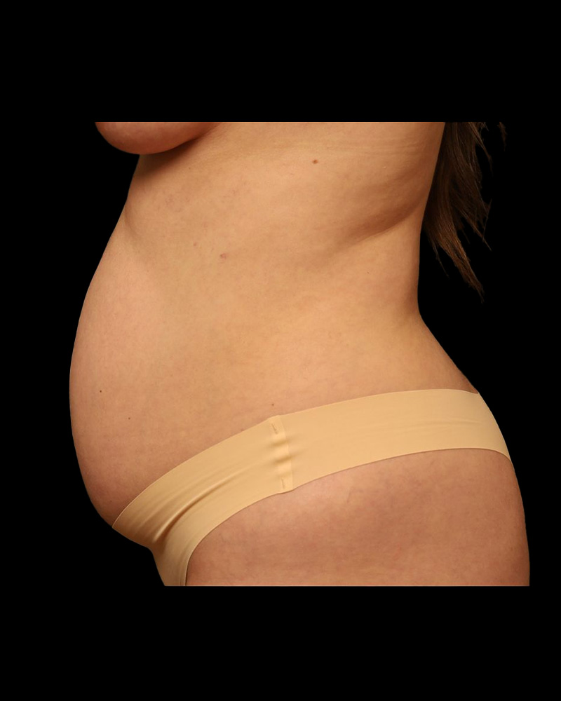 Tummy Tuck Before and After 33