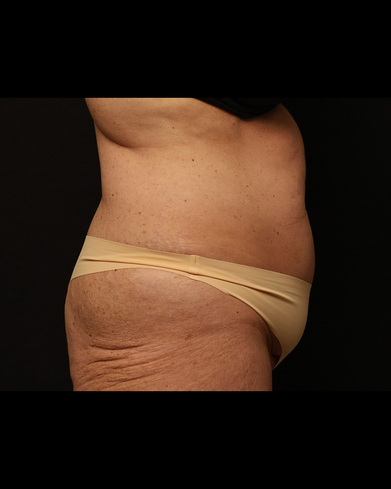Tummy Tuck Before and After 34