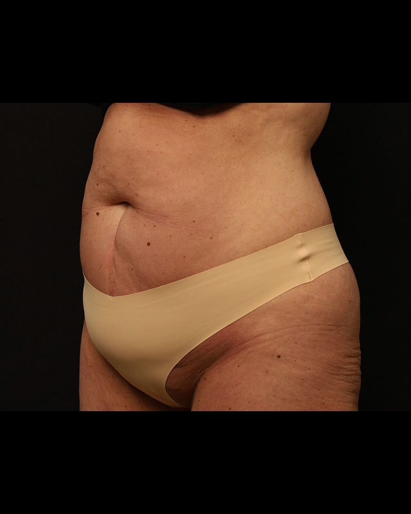 Tummy Tuck Before and After 34