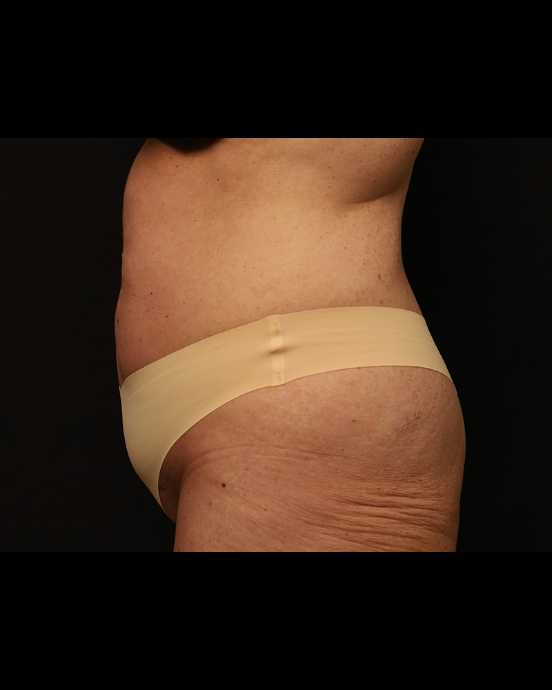 Tummy Tuck Before and After 34