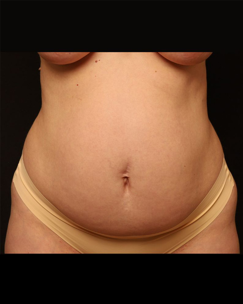 Tummy Tuck Before and After 35