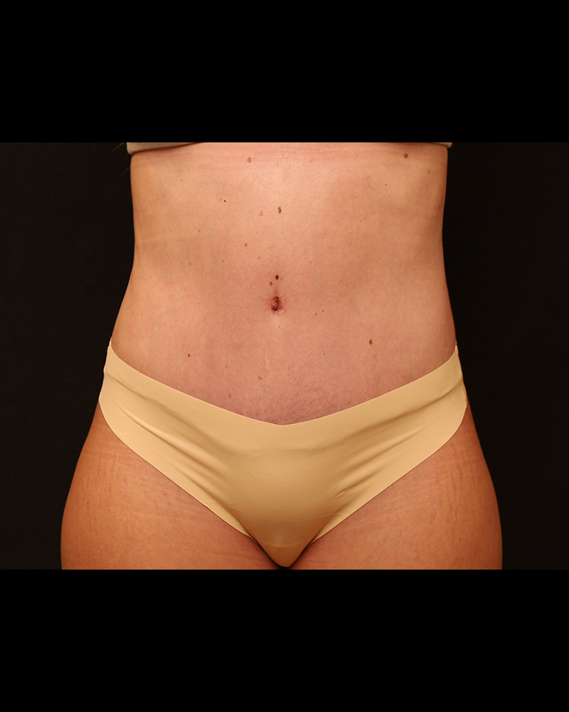 Tummy Tuck Before and After 07