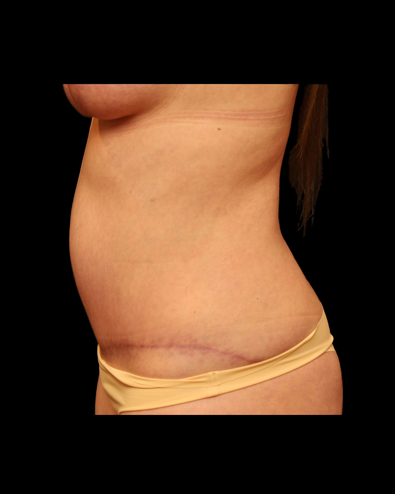 Tummy Tuck Before and After 35