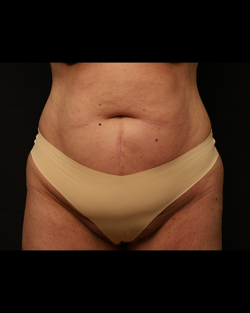 Tummy Tuck Before and After 36