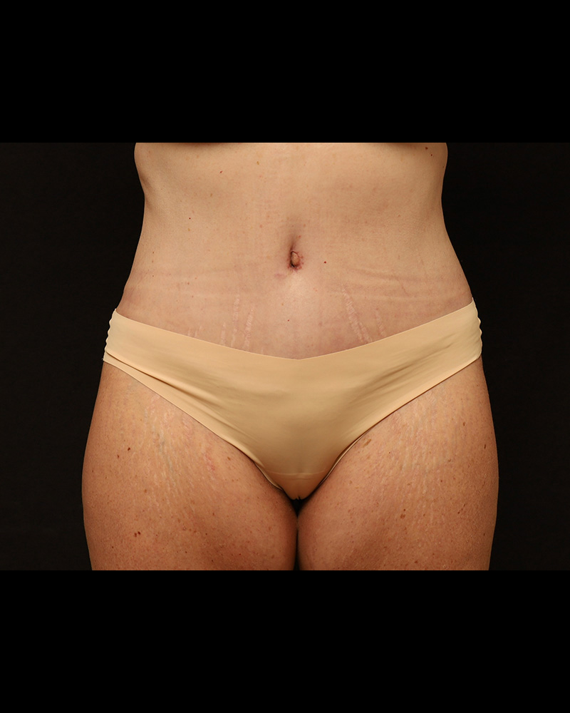 Tummy Tuck Before and After 07