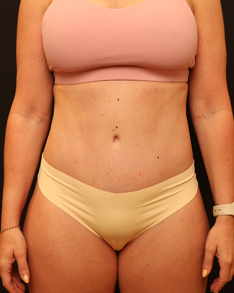 Tummy Tuck Before and After 07