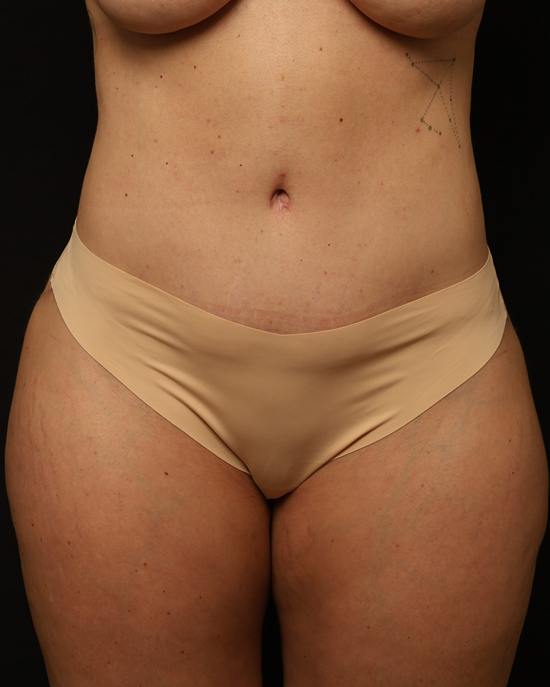 Tummy Tuck Before and After 07