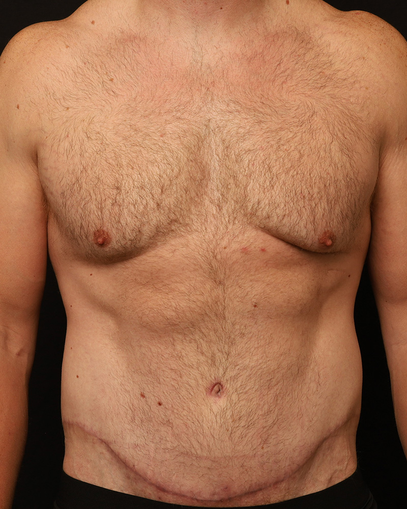 Tummy Tuck Before and After 07