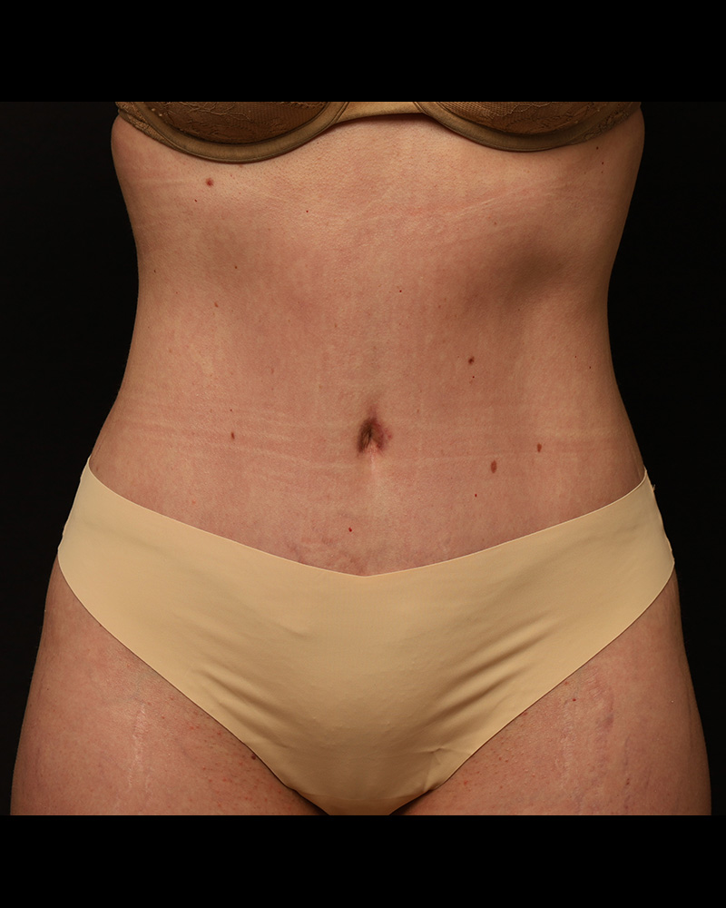 Tummy Tuck Before and After 07