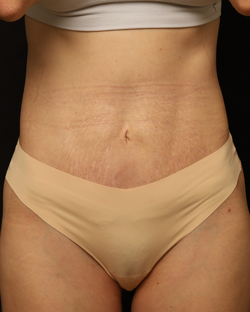 Tummy Tuck Before and After 07