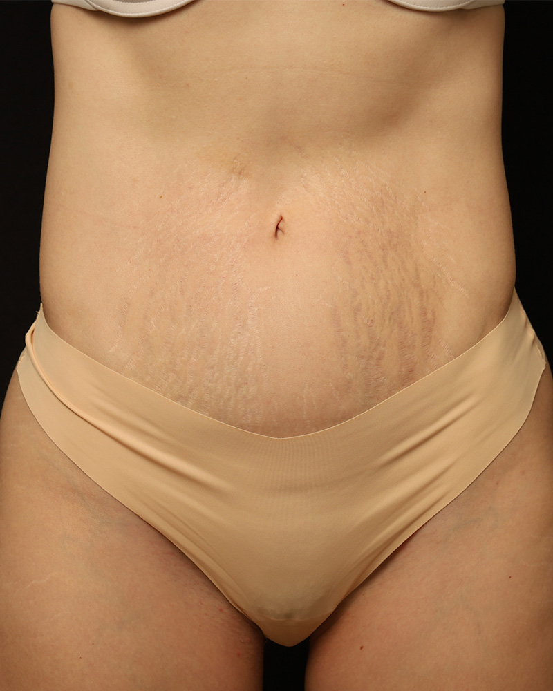 Tummy Tuck Before and After 42