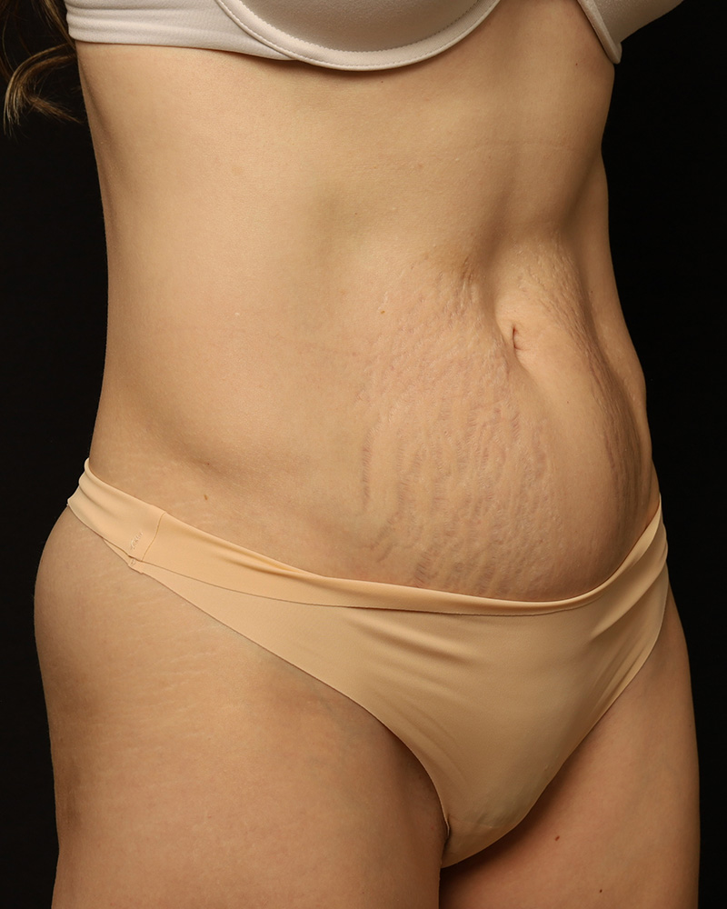 Tummy Tuck Before and After 42